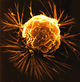 A breast cancer cell.